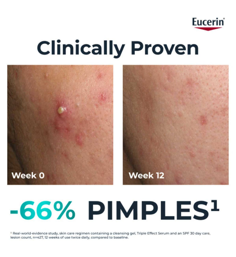 Eucerin acne treatment fluid Triple Action 40ml - British product