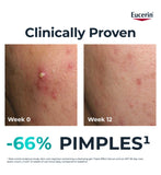 Eucerin acne treatment fluid Triple Action 40ml - British product