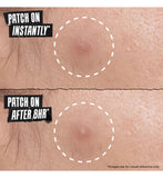 Kiehl's blemish patch with hydrocolloid, UK version