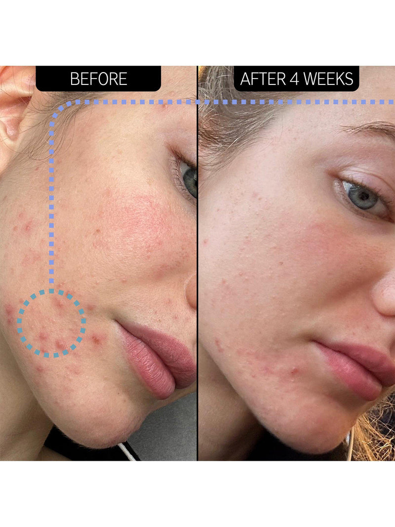 The INKEY List blemish clearing moisturiser with NovoRetin 50ml (British brand)