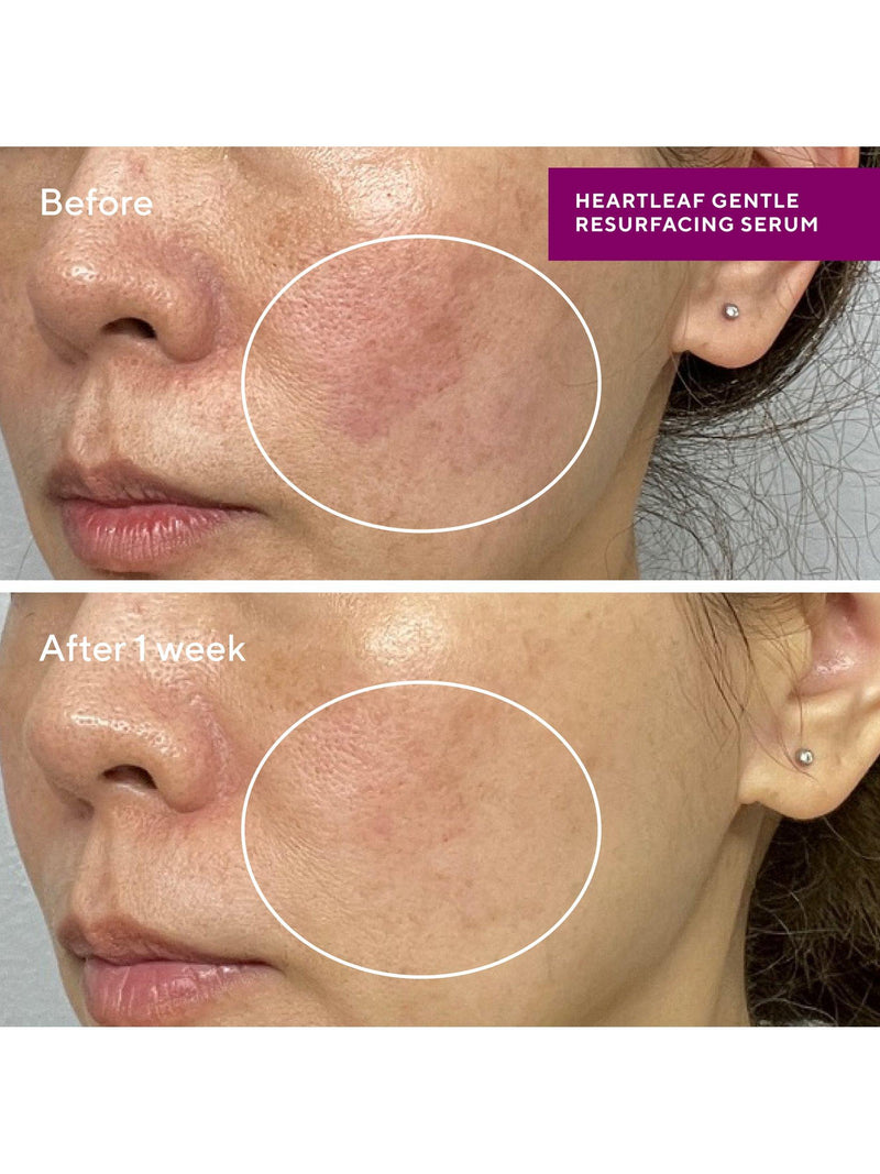 Murad Heartleaf Gentle Resurfacing Serum 30ml, imported from the UK