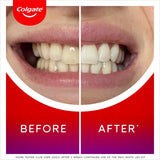 Sainsburys At-Home LED Teeth Whitening Kit with Serum and Mouthpiece- Buy online at McGrocer