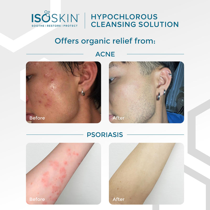 Isoskin hypochlorous cleansing solution spray, UK version