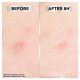 Garnier Invisible Blemish Patches 22 patches, imported from the UK