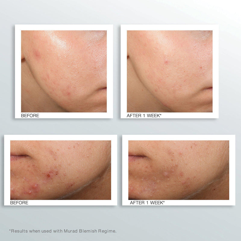 Murad Blemish Clarify Treatment 50ml, UK version