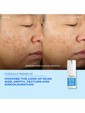 Murad InvisiScar resurfacing treatment 15ml (British brand)