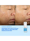 Murad InvisiScar resurfacing treatment 15ml (British brand)