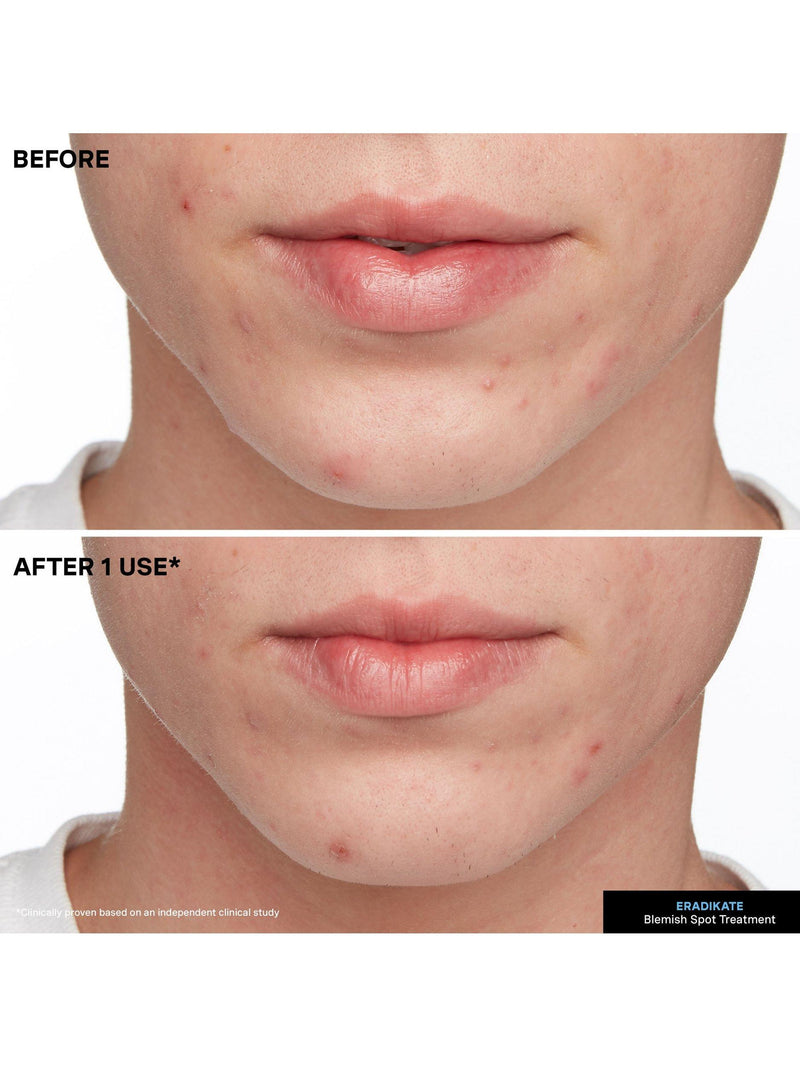 Kate Somerville EradiKate Blemish Treatment 30ml - British product