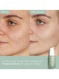 Caudalie Blemish Control Salicylic Serum 30ml - British product