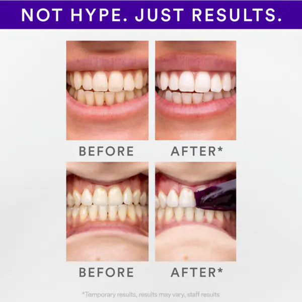 Hismile V34 whitening strips 14pk, UK version