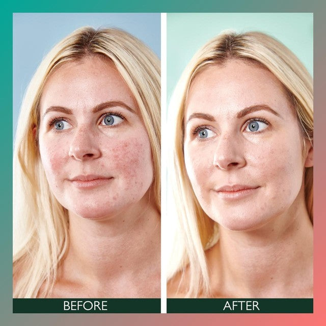 Sorted Skin Anti-Redness SPF50 day cream 30ml (British brand)