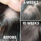 Hair Loving Derma Roller micro-needling device, UK version