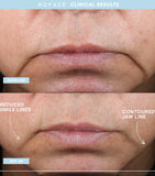 NuFACE Mini+ Facial Toning Device Starter Kit, imported from the UK