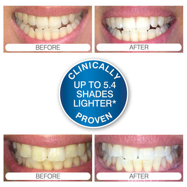 Rio teeth whitening advanced blue light kit, imported from the UK