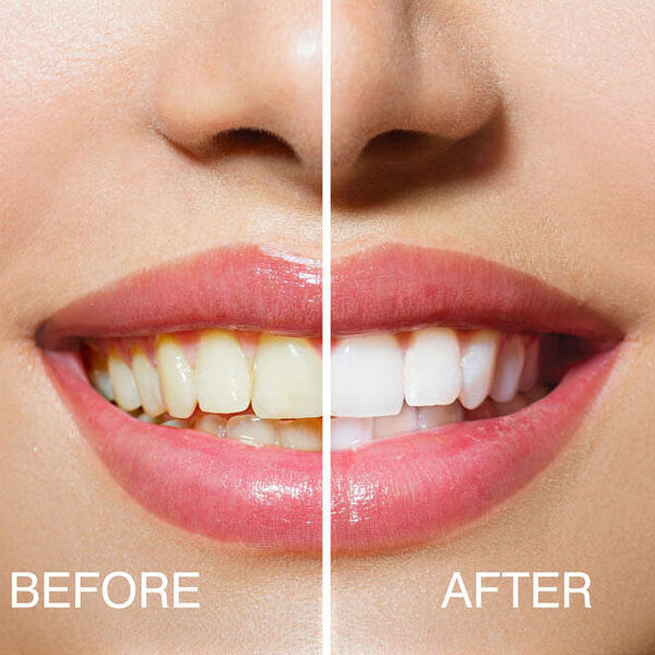 Rio teeth whitening advanced blue light kit, imported from the UK