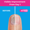 Excilor Ultra nail fungus solution 30ml, imported from the UK