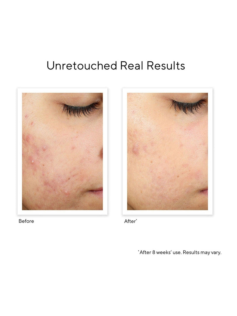 Murad InvisiScar Recovery Treatment face serum 15ml, imported from the UK