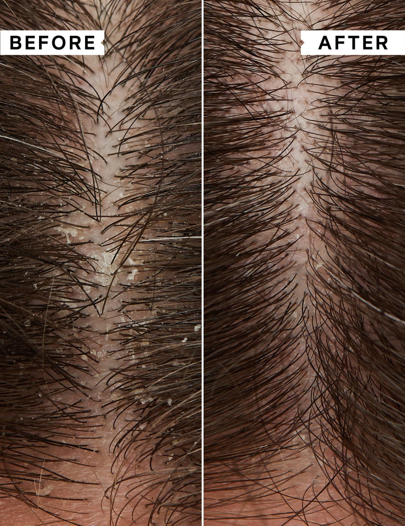 Philip Kingsley flaky itchy scalp treatment kit with mask shampoo and toner - British product