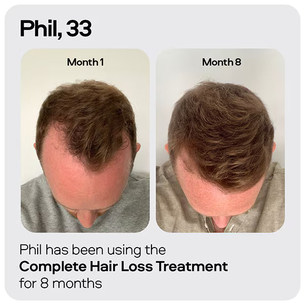 Sons Minoxidil hair regrowth solution 5% (British brand)