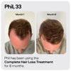 Sons Minoxidil hair regrowth solution 5% (British brand)