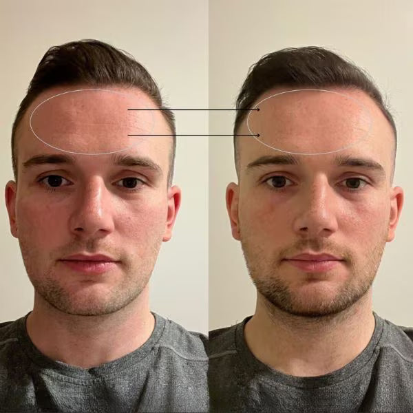 Beautypro Photon LED Facial Mask - British product