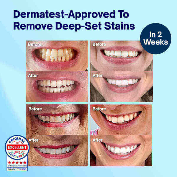 MySweetSmile teeth whitening strips 21 treatments imported from the UK