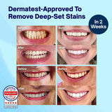 MySweetSmile teeth whitening strips 21 treatments imported from the UK
