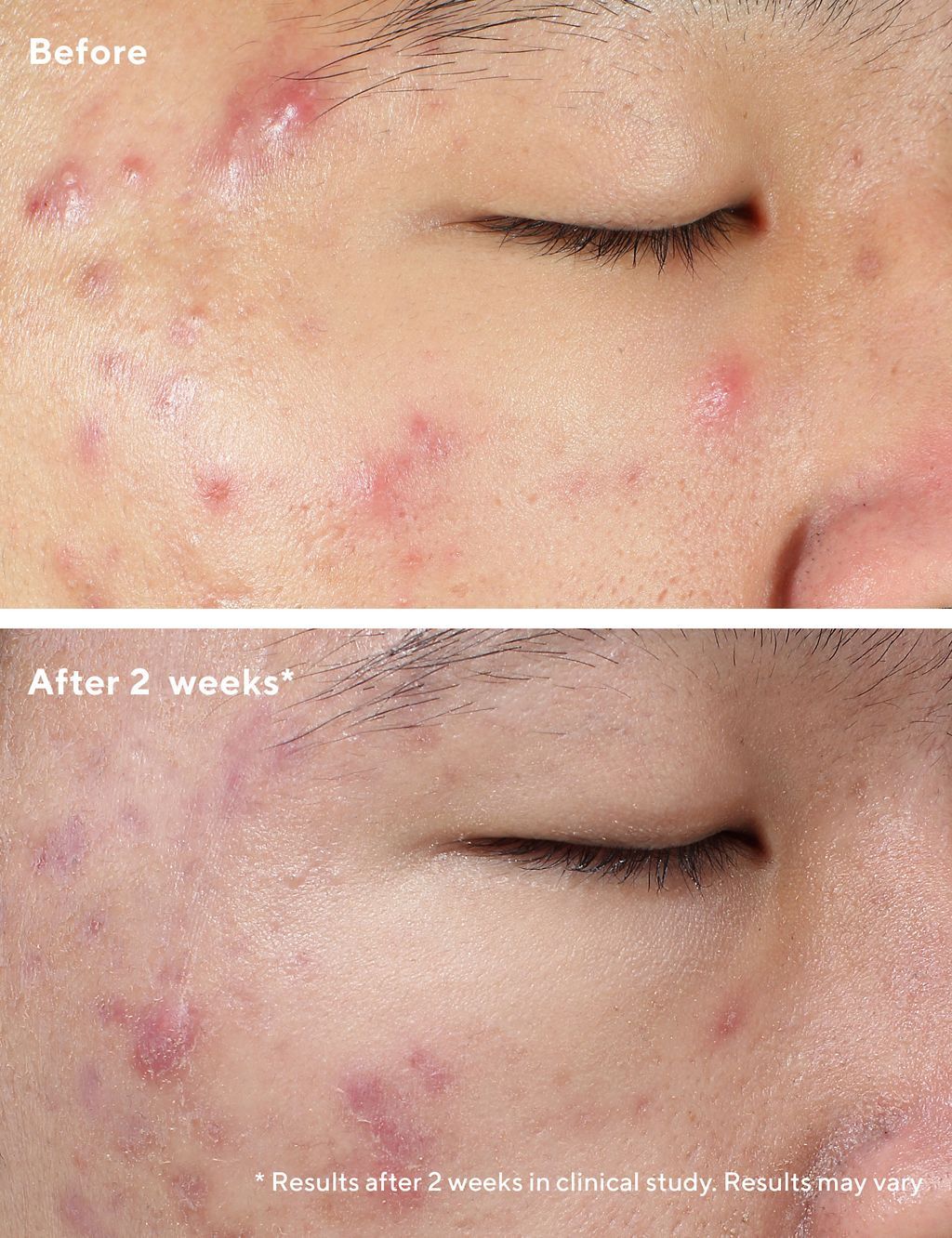 Deep Relief Blemish Treatment 30ml