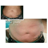 âme pure Body Basic | Stretch Marks 0.75mm - McGrocer