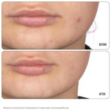 Nip+Fab Retinol Fix Blemish Treatment Gel 10%   15ml