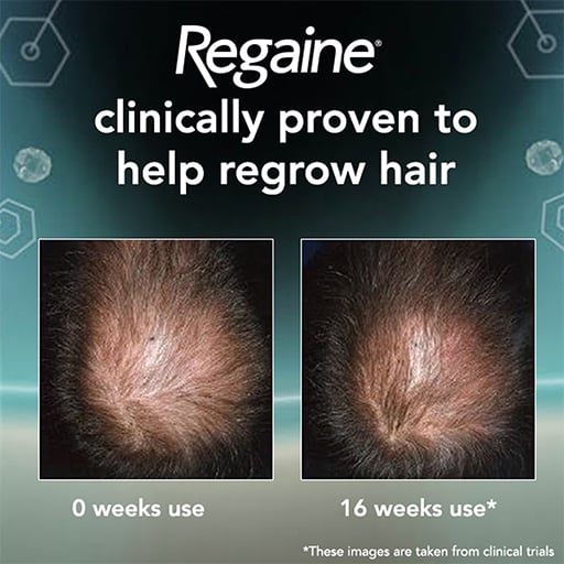 Thicker, Fuller Hair with REGAINE FOR MEN EXTRA STRENGTH: Real Reviews and Results