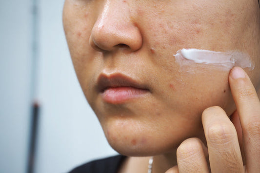 Top 17 Acne Scar Treatments Dermatologists Swear By