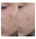 BYOMA blemish clearing paste 15ml - British product