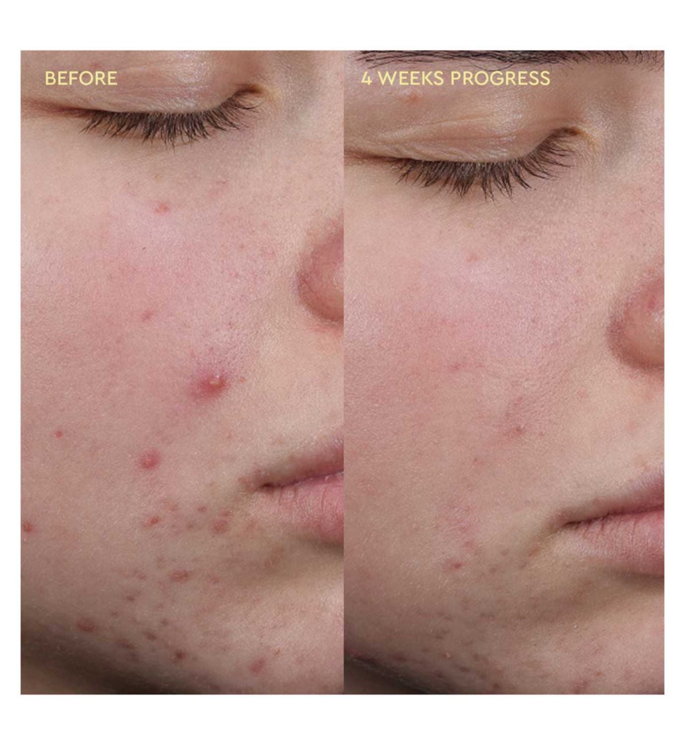 BYOMA blemish clearing cleanser 175ml, UK version