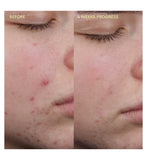 BYOMA blemish clearing cleanser 175ml, UK version