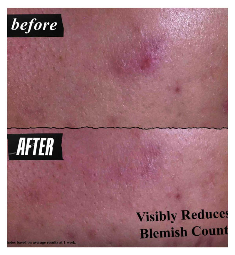 Kiehl's Expert Blemish Cleanser 125ml, imported from the UK