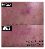 Kiehl's Expert Blemish Cleanser 125ml, imported from the UK