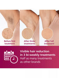 Philips Lumea 7000 IPL hair removal device white, imported from the UK