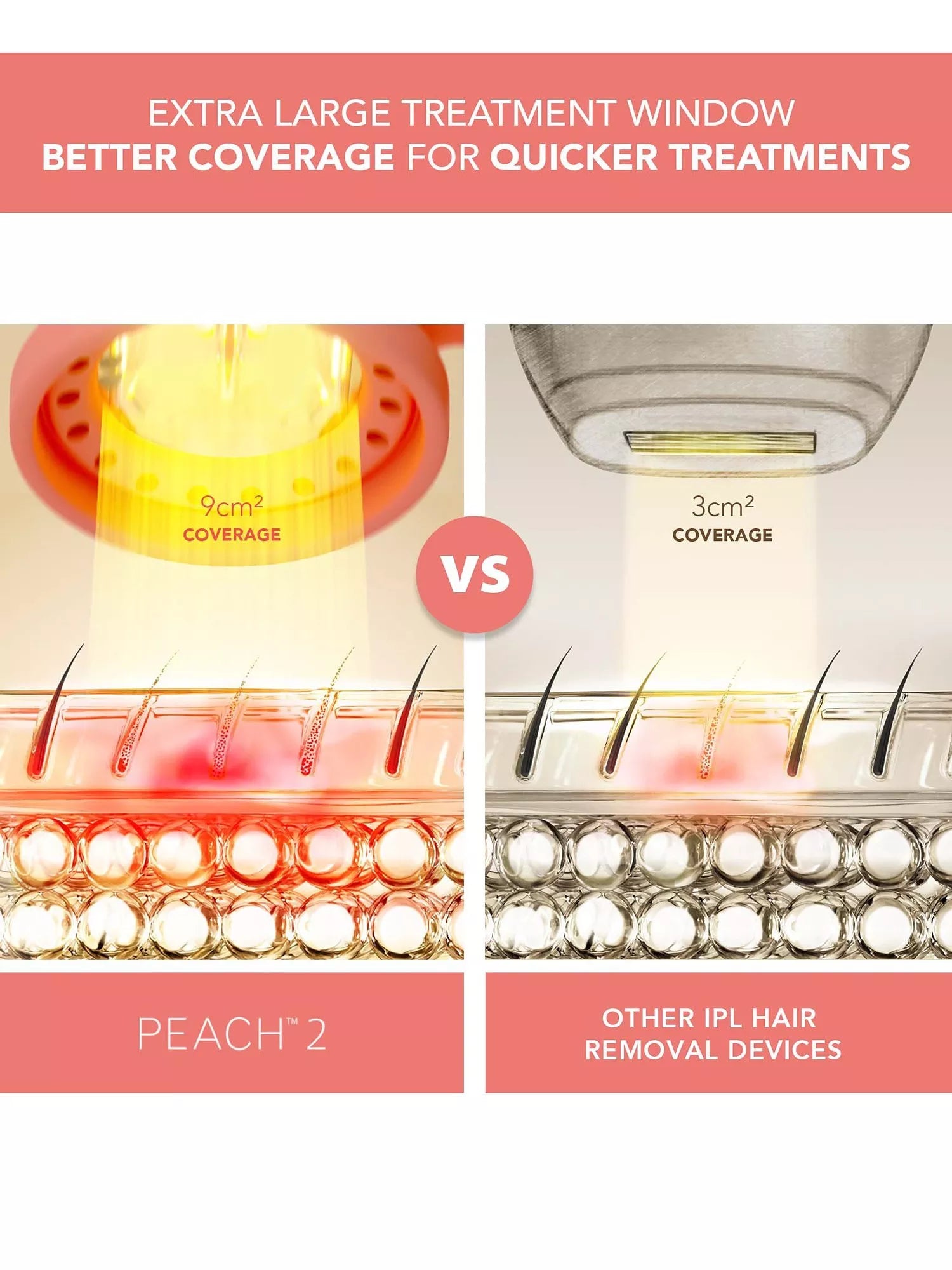 FOREO PEACH 2 IPL hair removal device (British brand)