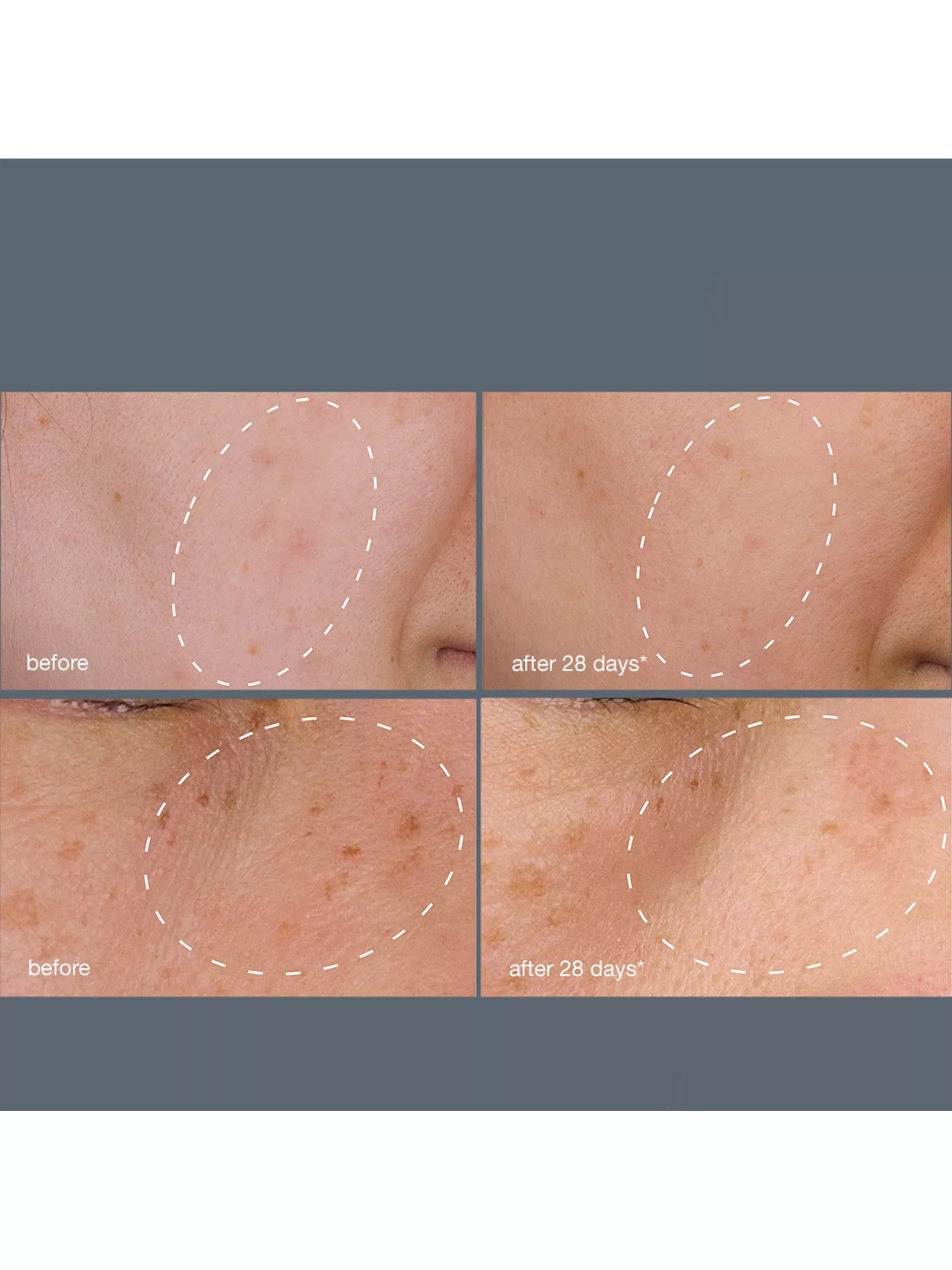 Dermalogica dark spot treatment system with serum and peel - British product