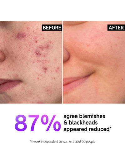John Lewis Salicylic Acid Gel Cleanser for Daily Use on Blemish-Prone Skin- Buy online at McGrocer