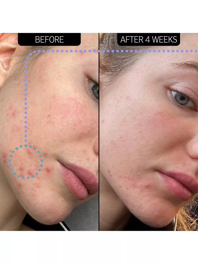 The INKEY List blemish clearing moisturiser with NovoRetin 50ml (British brand)