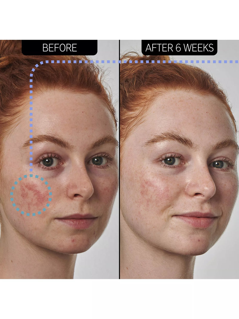 INKEY List Azelaic Acid Serum 30ml, imported from the UK
