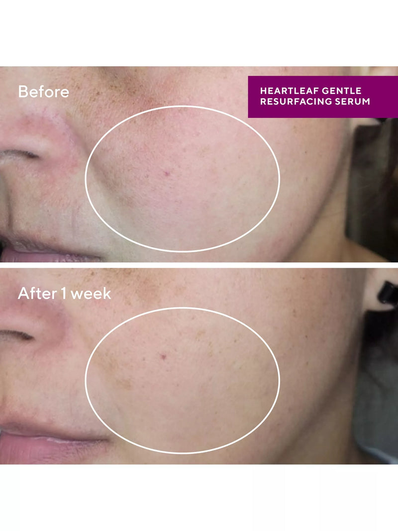 Murad Heartleaf Gentle Resurfacing Serum 30ml, imported from the UK