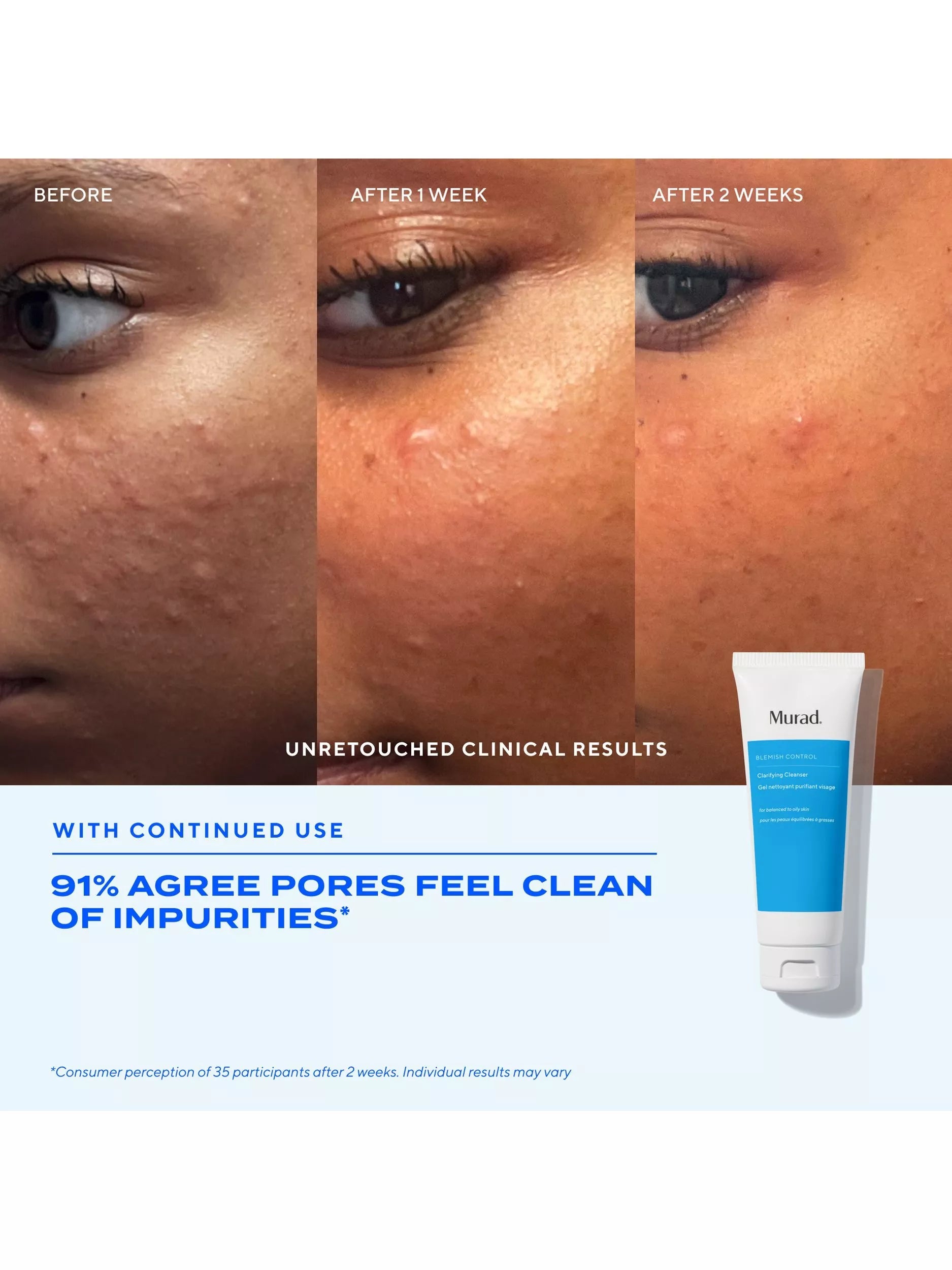Murad Blemish Control Clarifying Cleanser 148ml, UK version