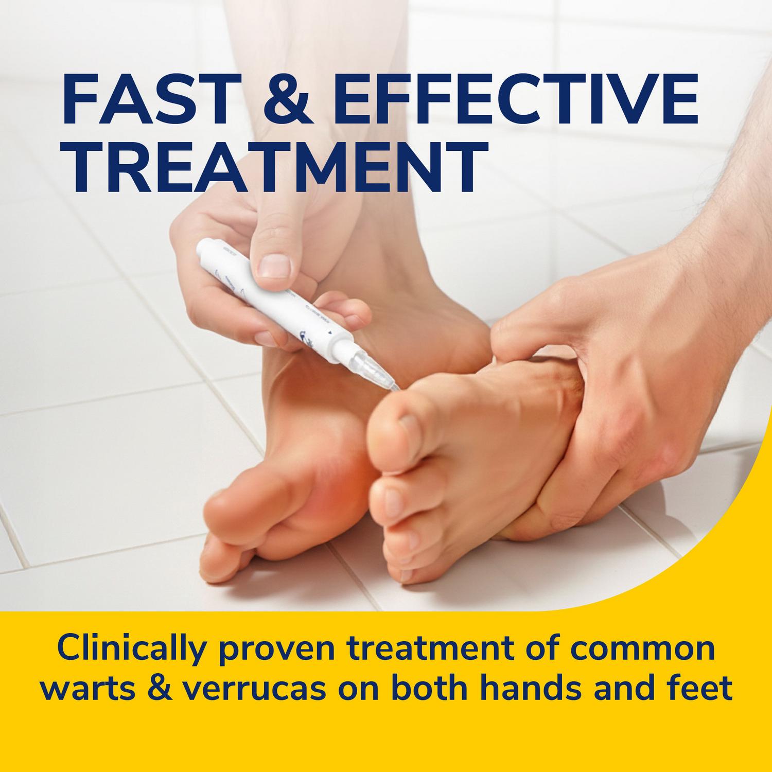 Scholl Verruca & Wart Treatment Pen 2ml (British brand)