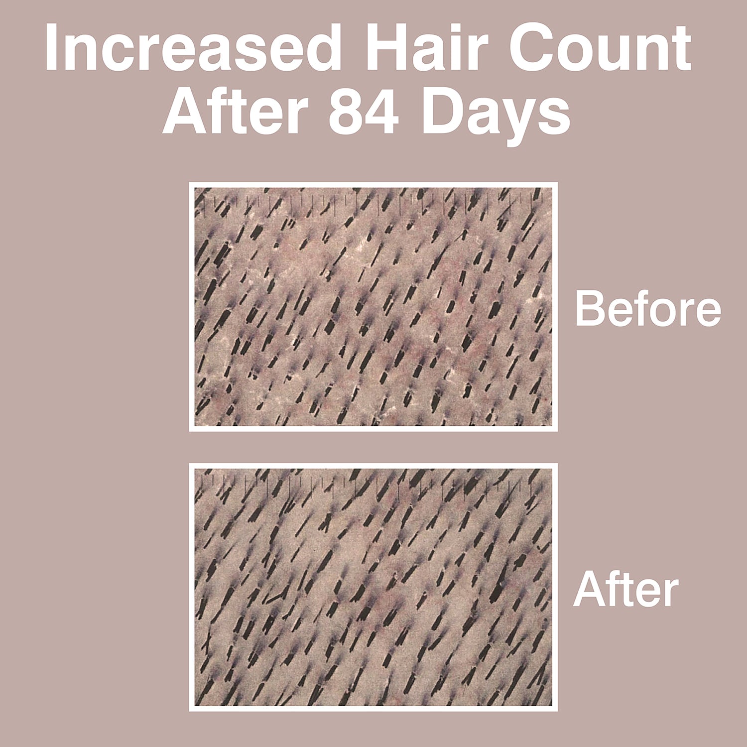 Rio HairGrow laser headband for hair regrowth, imported from the UK