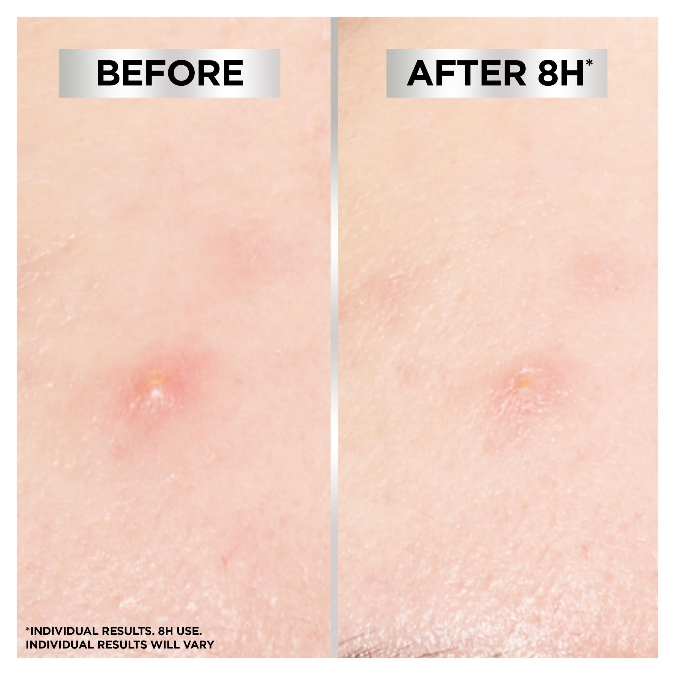 Garnier Invisible Blemish Patches 22 patches, imported from the UK