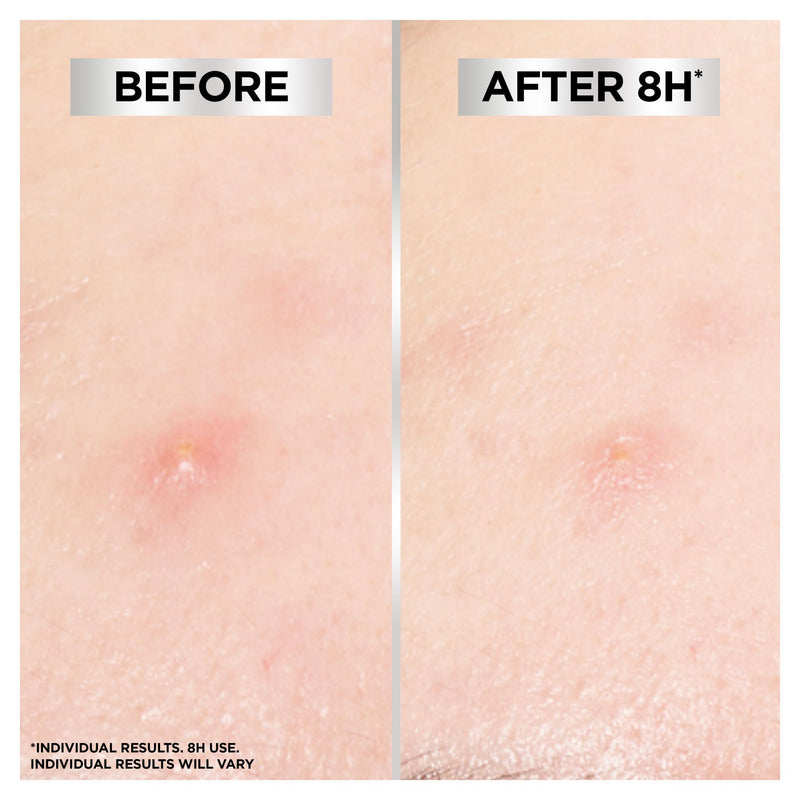 Garnier Invisible Blemish Patches 22 patches, imported from the UK