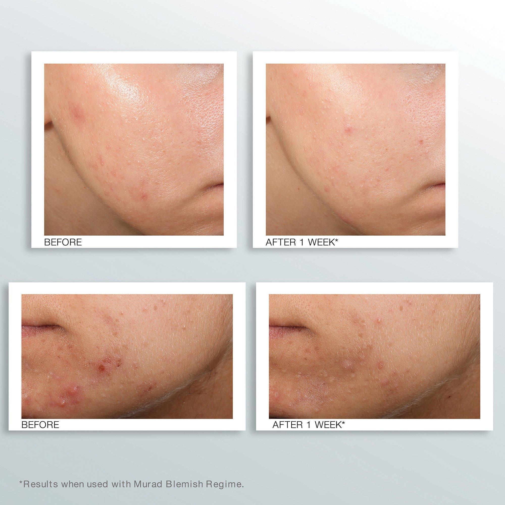 Murad Blemish Clarify Treatment 50ml, UK version